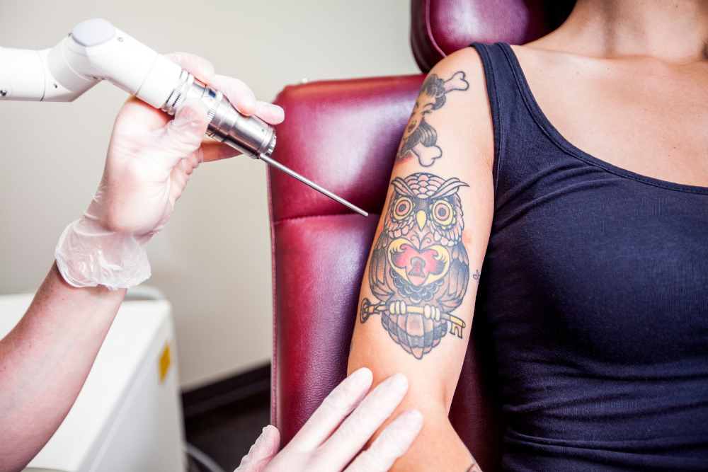 Best Tattoo Removal Pricing in Greenville, South Carolina