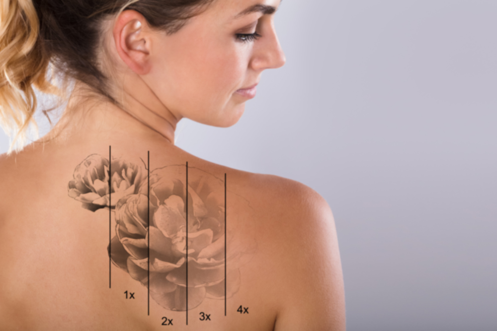 Best Tattoo Removal Results in Anderson, South Carolina