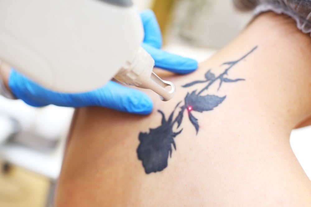 Tattoo Removal Clemson SC