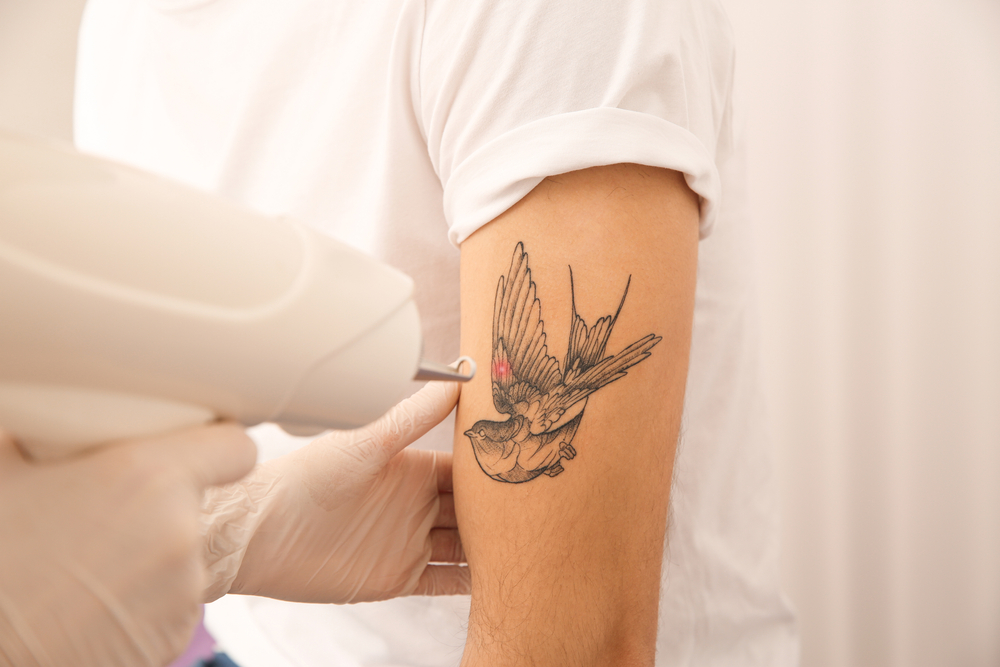 Laser Tattoo Removal Cost Near Clemson, SC: What to Expect Per Session