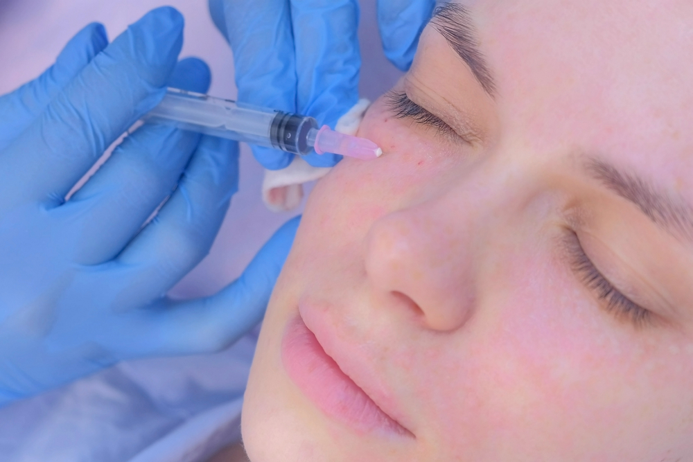 How to Find the Best Under-Eye Filler Specialist in Anderson, SC for Dark Circles and Hollow Eyes