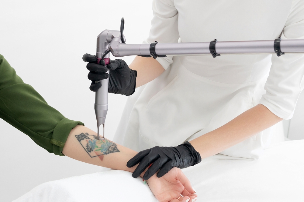 Best Tattoo Removal Treatments in Greenville SC