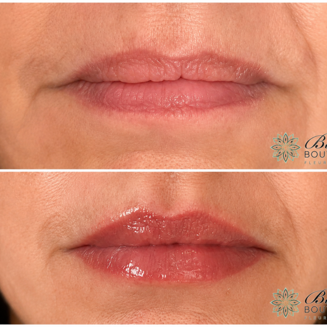 Lip Filler