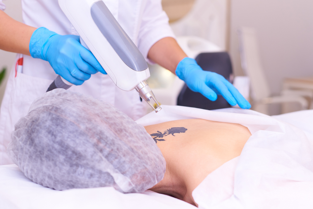 Tattoo Removal Pricing in Easley, SC: A Complete Guide to Treatment Costs