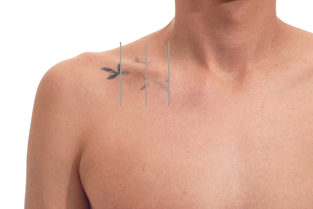 How Many Sessions Does Tattoo Removal Take in Anderson SC?