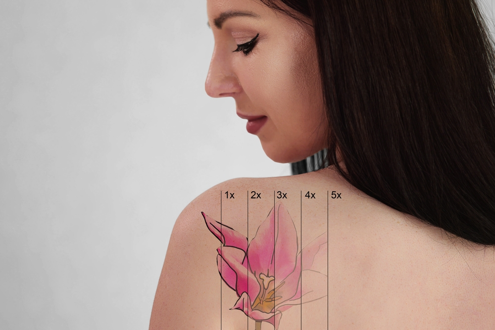 Tattoo Removal in Clemson, SC