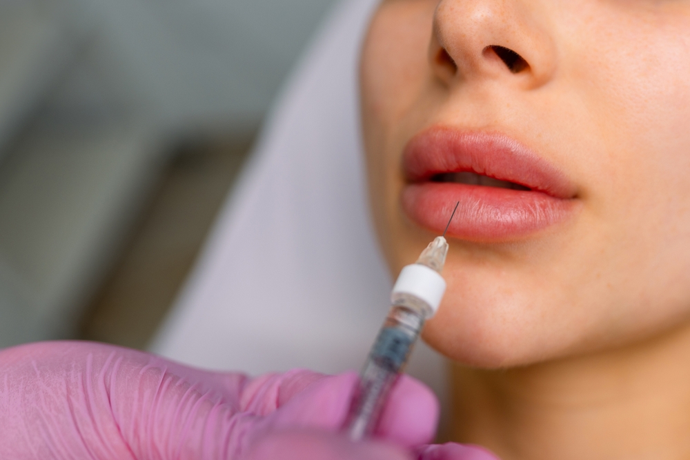 Lip Filler Appointments in Clemson, SC: Are You a Good Candidate?