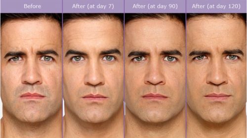 male-botox_orig